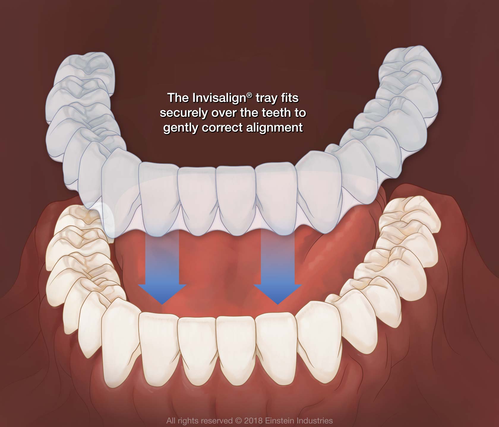 invisalign mouthpiece